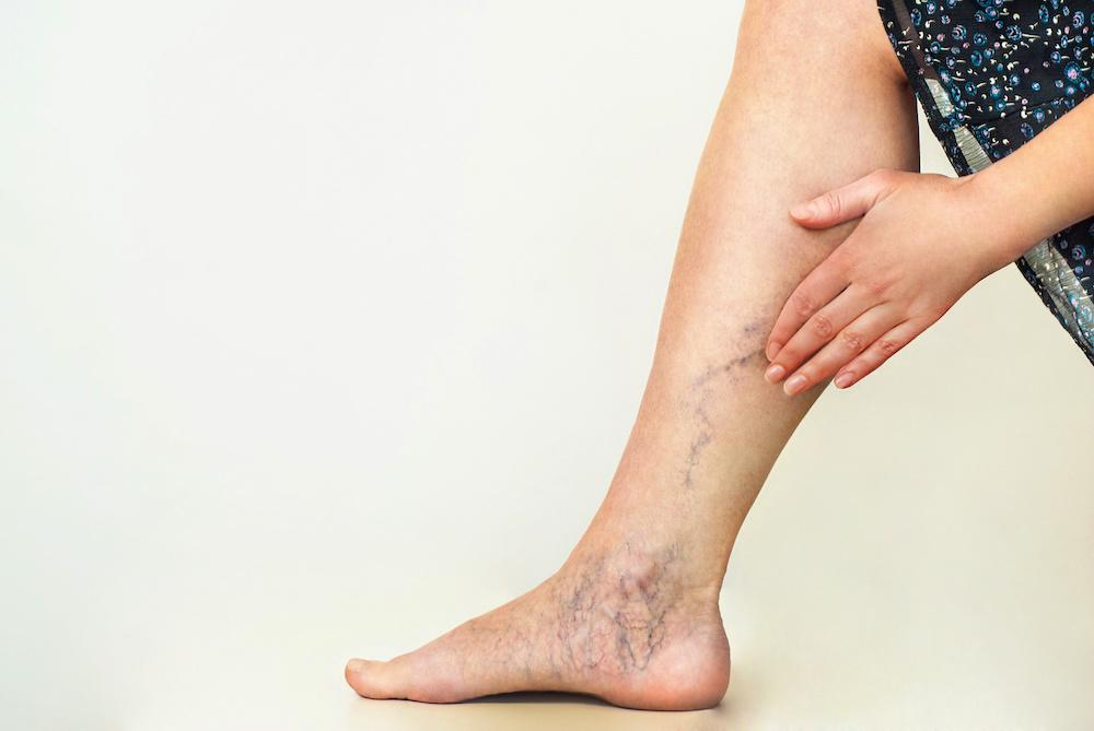 Understanding Varicose Veins: A Comprehensive Guide to Prevention