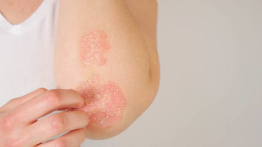 Plaque-Psoriasis verstehen: Symptome, Ursachen und Behandlungen