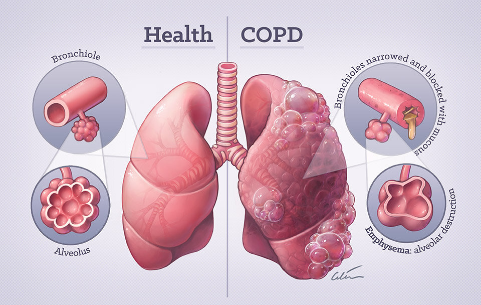 O que é a Doença Pulmonar Obstrutiva Crônica (DPOC)?