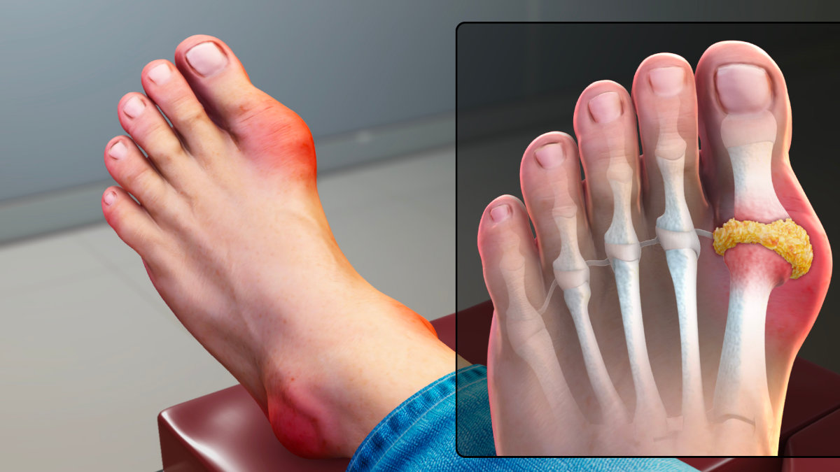 Gout : Symptômes, Causes et Traitements